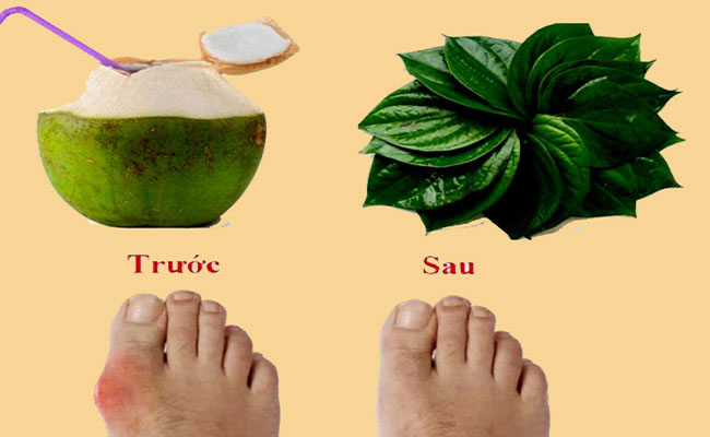 Chữa bệnh gút bằng quả dừa: Bài thuốc đơn giản, dễ làm, hiệu quả tốt